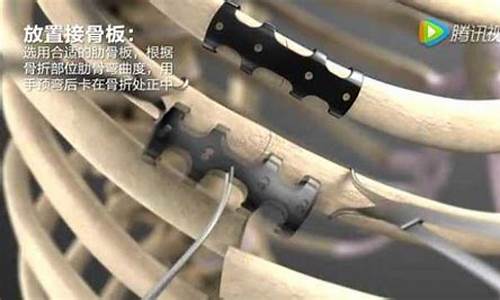 肋骨固定钛合金价位_肋骨手术用钛合金固定术后不取有后遗症吗?